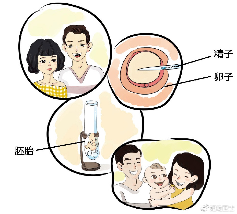 捐卵手术