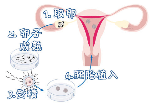 爱心捐卵